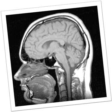 Forskning Hjärnans utseende kan man studera med magnetröntgen. Flera olika områden har betydelse vid autism.