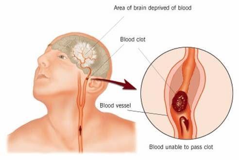 Stroke Subarachnoidal blödning