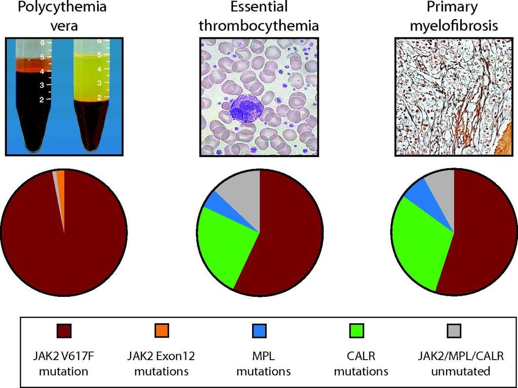 Frekvens av JAK2, CALR, och MPL mutationer vid PCV, ET och MF Jyoti Nangalia, and