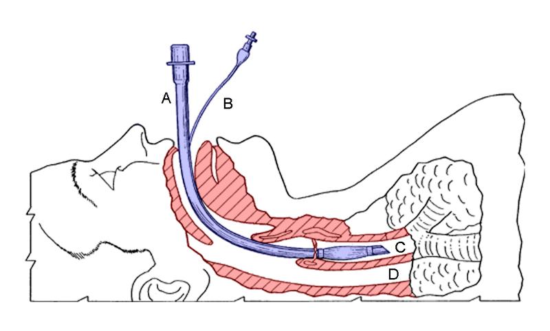 Endotrakealtub (ETT) Det är av största vikt att säkert tillgodose syrgasförsörjning till vävnaderna och utvädring av koldioxid.