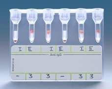 Evans syndrome (antiplatelet antibodies and hemolytic antibodies) Cold antibody autoimmune hemolytic anemia IgM IDIOPATISK Infektiös mononukleos (Epstein Barr) (anti-i) Paroxysmal cold hemoglobinuria