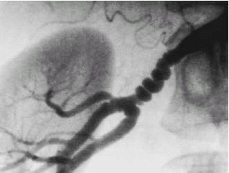 36-årig kvinna med huvudvärk Renal angiografi konfirmerar en långsträckt stenos som behandlas med angioplastik (