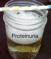 Proteinuri - definition Normalt < 30 mg/24 h Mikroalbuminuri