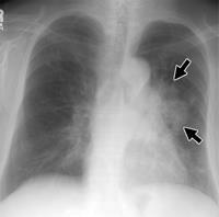 2009/02 in p g a andningsbesvär, tilltagande hosta samt hemoptys, CRP 97. Lungrtg+DT thorax - lobära infiltrat ffra vä.
