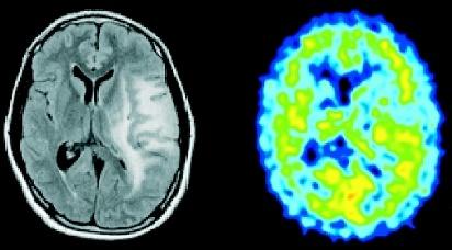 Histopatologisk diagnos (tillsammans med den radiologiska bilden) är förenlig med gliomatosis cerebri. givande hjärna.