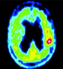 Till skillnad från FDG är bakgrundsupptaget av MET i den friska hjärnan lågt, vilket möjliggör god differentiering mellan tumör och icke-tumörområden.