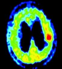 fortfarande begränsad [35]. PET med spårsubstansen 124 I-IudR, en tymidinanalog, har använts för mätning av tumörens proliferationsaktivitet och har befunnits vara högspecifik [36].