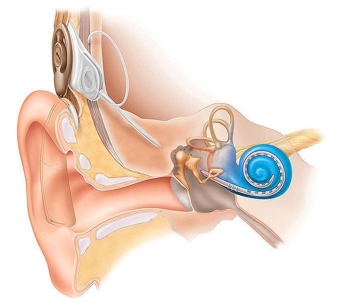Bakgrund Cochleaimplantat (CI) är ett hörselhjälpmedel som kan ge barn med grav hörselnedsättning eller dövhet möjlighet att höra ljud och uppfatta talat språk.
