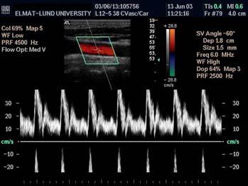 Pulsat Doppler System Aliasing