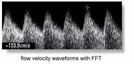 Duplex Duplex CWD - Kontinuerlig Doppler CWD