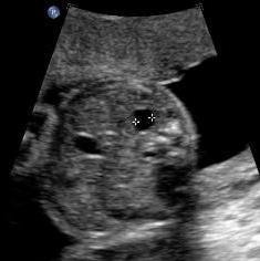 Ultraljudsfynd av vidgat njurbäcken hos foster Vid screeningultraljud graviditetsvecka 16-20: Om njurbäckenvidgning 6 mm (anterioposteriort mått i tvärsnittsbild) beskrivs eventuella varningssignaler