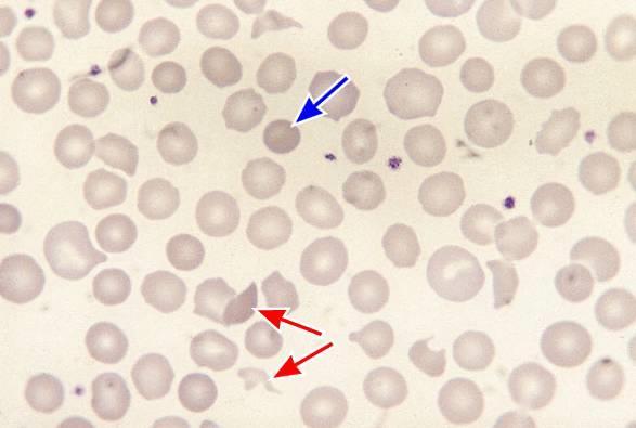 Schistocyter/Fragmentocyter