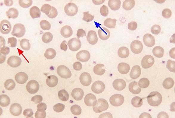 Keratocyter keras: horn (grekiska) Kännetecken Oregelbundet sammandragen cell som har ett eller flera runda utskott och saknar central uppklarning De vanligaste har två utskott och kallas