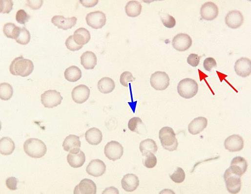 Kännetecken Hemoglobin ansamlat i ena ändan av cellen Uppklarning i ena delen av cellen där cellmembranen smält samman Orsakas av oregelbunden sammandragning av cellen efter membranskada eller efter