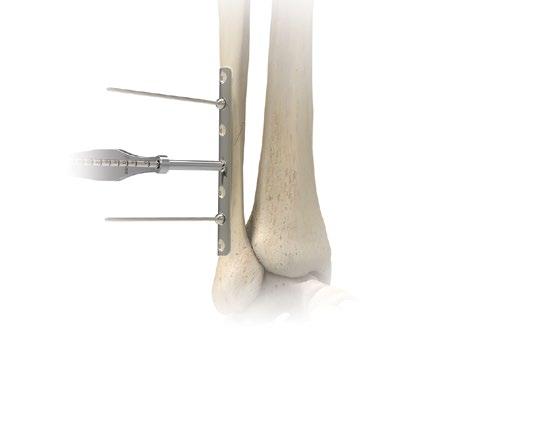 Borrar och nycklar som används för att föra in 3,5 mm icke-låsbara ar och 4,0 mm ar för spongiöst ben har SVARTA epoxiband och anges längst ned på sidan.