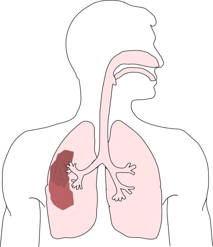 Nosokomial pneumoni sjukhusorsakad pneumoni