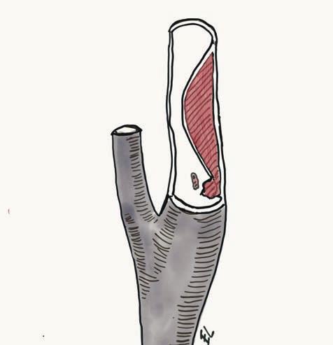 Stroke Arteria carotis interna Hematom Arteria carotis externa Emboli Arteria carotis communis Bild 1. Bilden illustrerar en dissektion av arteria carotis interna.