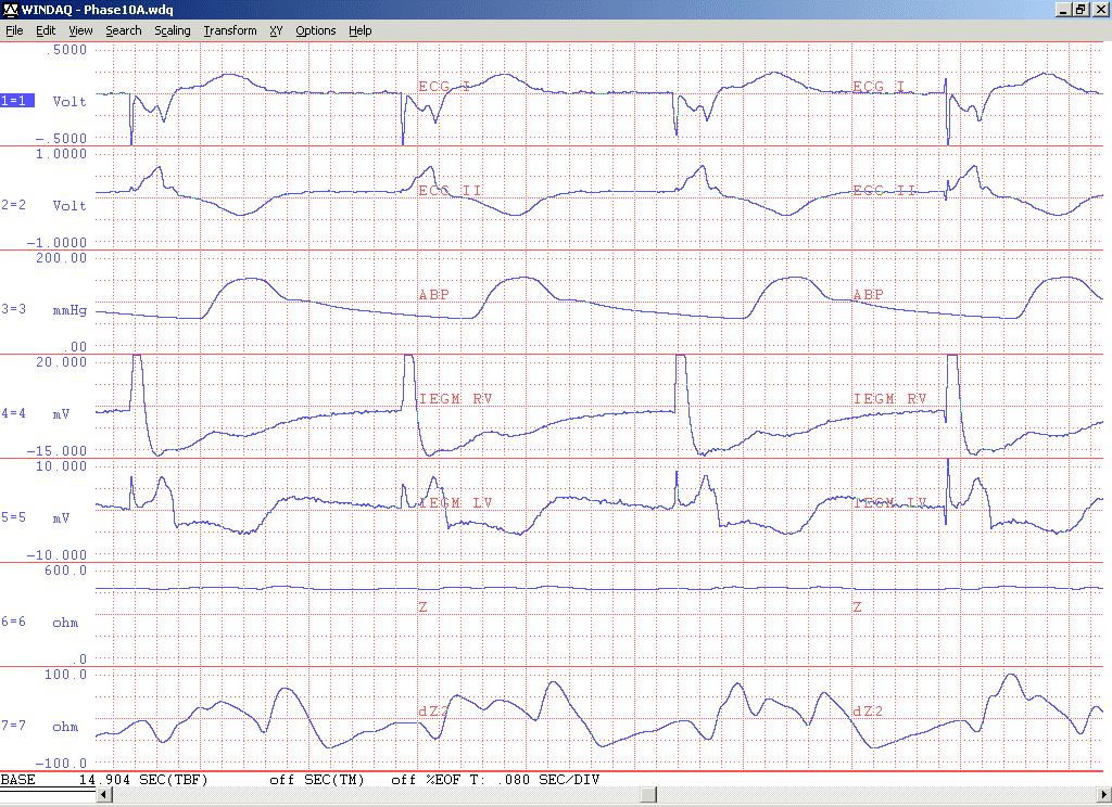 RV stimulation 60 bpm V R V R 160 ms R L R L