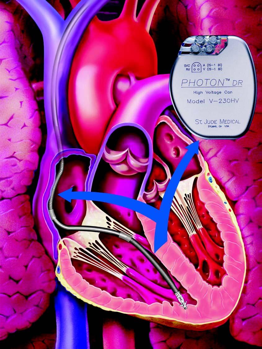 Defibrillation System 4 electrode lead sensing RV stimulation