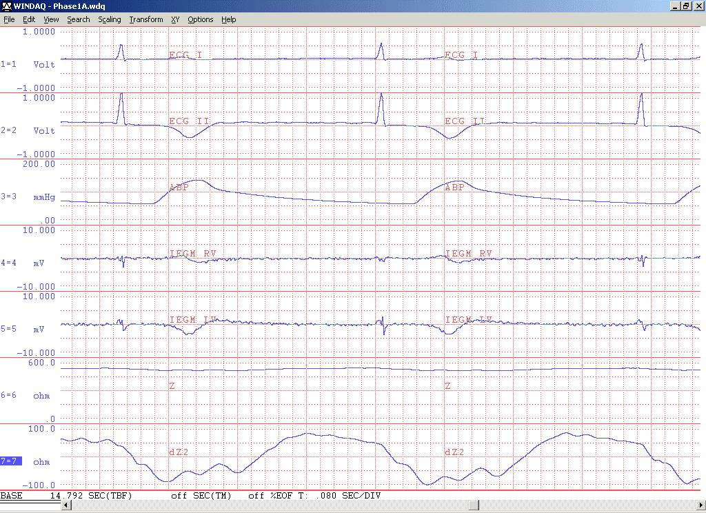 AF, nodal rhythm (~ 40 bpm)