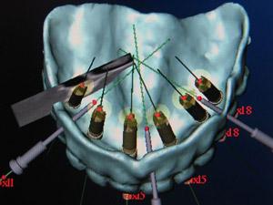 Bentransplantat och sinuslyft Normalt krävs det minst 10 mm ben för att få ett stabilt implantat(10).