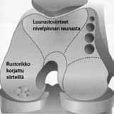 2.3 Korrigerande operation av ledbroskskada Ledbroskets förmåga att återhämta sig själv är nästan obefintlig och därför kräver en stor skada på ledbrosket orsakad av en olycka eller sjukdom ett