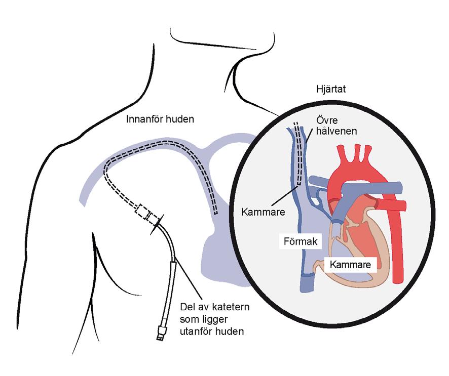 6. CENTRALA INFARTER Central venkateter CVK Om du ska få läkemedel som dropp i blodet kommer du troligen att behöva en venkateter.