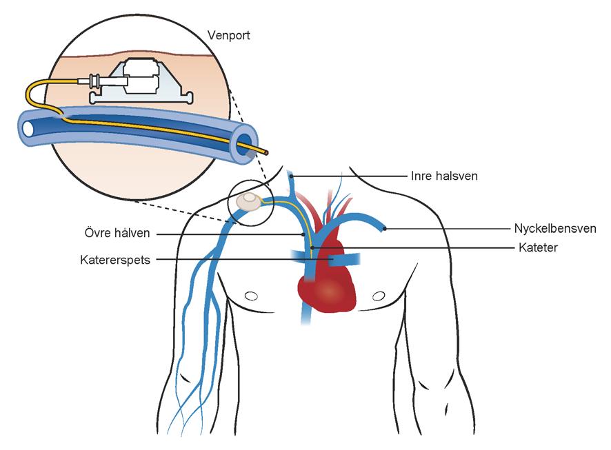 6. CENTRALA INFARTER Subkutan venport SVP Om du ska få läkemedel som dropp i blodet kommer du troligen att behöva en venkateter.