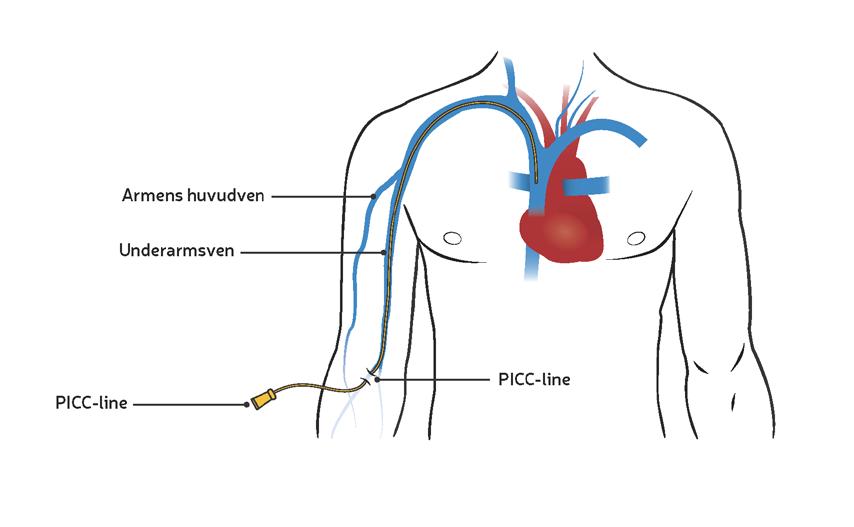 6. CENTRALA INFARTER PICC-line Om du ska få läkemedel som dropp i blodet kommer du troligen att behöva en venkateter.