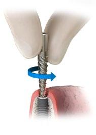 Hämta upp skadade implantat Hämta upp skadade implantat För att avlägsna skadade implantat eller implantat med skadade inre gängor kan det krävas alternativa metoder, t ex att