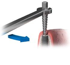 Använd Implant Retriever I situationer där bara en liten bit av skruvhålet återstår kan det vara svårt att få tillräcklig friktion.