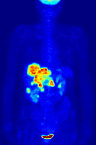 Radionuklider Användning: PET scanning Positron