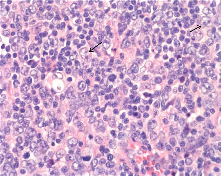 Diffust storcelligt B-cells lymfom DLBCL är en tumör som består av stora B-lymfocyter.