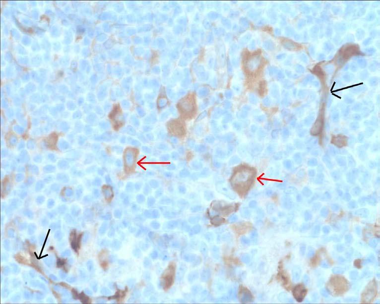 Hodgkins tumörcell eller någon annan cell. Alla celler med smala cellutskott och långsträckt form (dendritiska celler) som var bruna tolkades som benigna, se figur 5.