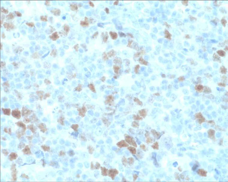 Vid DLBCL var det bara problem med infärgningen av BCL-6 och BOB-1. De färgades in ganska svagt, se figur 8. Figur 8 BCL-6 färgning vid Diffust storcelligt B-cellslymfom.