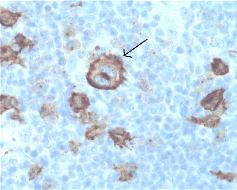 NLPHL ingår inte i denna studie, p.g.a. att det är så få fall i Karlskrona. CHL är en lymfoid tumör utvecklad från B-lymfocyter.