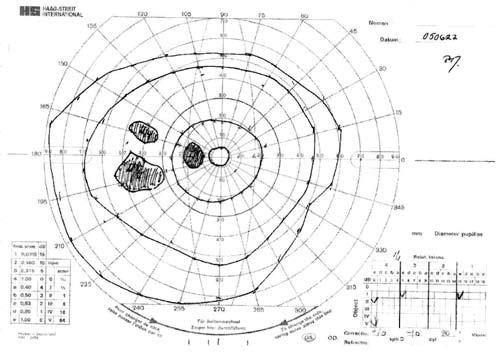 Synfältsundersökningar vid laserbehandlad diabetesretinopati En person född 1957 som har diabetes typ 1 sedan 35 år har en retinopati som har medfört behandling med fotokoagulation ( laserbehandling