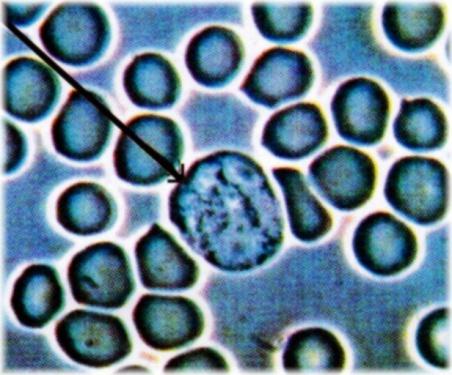 Leukocyter Normal urin - negativ Positivt test ses vid urinvägsinfektion samt vid inflammationer i njurar och urinvägar Spår vid enstaka till fällen OK Upprepade spår