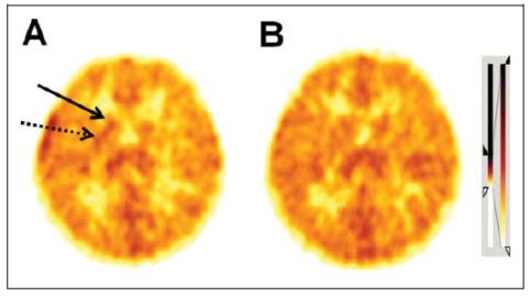 PET vid PANDAS Liganden [ 11 C]-PK11195 binder translocator protein receptors (TSPO) som uttrycks av