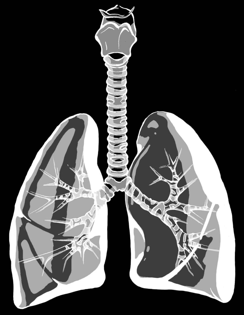 Cudurka Daran ee Ku Dhaca Xididka Loo Yaqaano Pulmonary (oo marka magaciisa la soo gaabsho afka qalaad loogu yeero