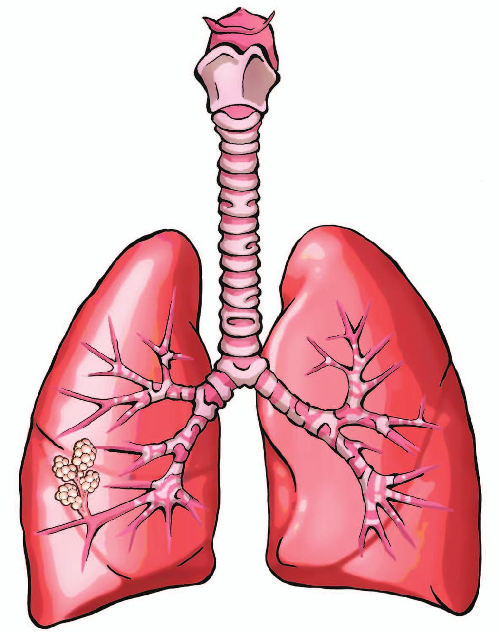 Waa maxay COPD? Qaab dhismeedka sambabada Sambabadu waxay ka kooban yihiin hilibka sambabka, duleelada hawadu qaado iyo meelaha hawadu gasho.