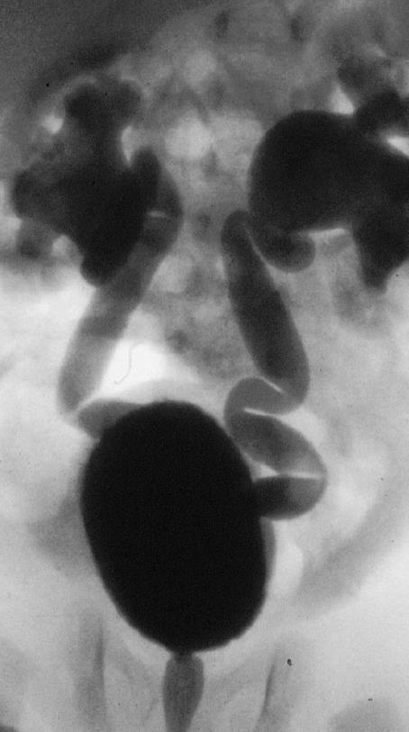 Vesikoureteral reflux Bakåtflöde av urin från urinblåsan till njurens samlingssystem Ärftlig komponent Påvisas med cystografi 0.