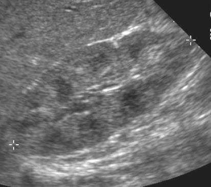 Normala njuren på ultraljud Njure hos 3 mån pojke Ekogenicitet i cortex =