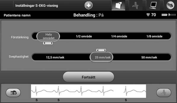 Obs! Amplitudinställningar och justeringar av visningshastighet för rullande realtids-s-ekg:n och registrerade S-EKG:n påverkar bara skärminställningarna och har ingen inverkan på pulsgeneratorns