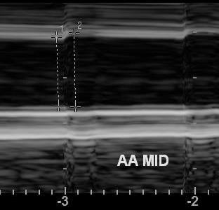 M-mode aorta