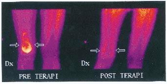 Figur 9. Upptag av Tc m -MIBI inom ett osteosarkom grad IV distalt i höger femur före (t v) och efter preoperativ cytostatikabehandling (pilar).