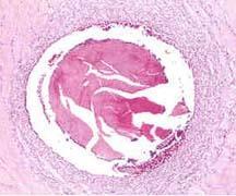 Resorberbara suturer Vävnadsstöd Nyckelbegrepp: Vävnadsstöd (hållfasthetsförlust) in vivo (Tensile strength retention, TSR, eller Breaking