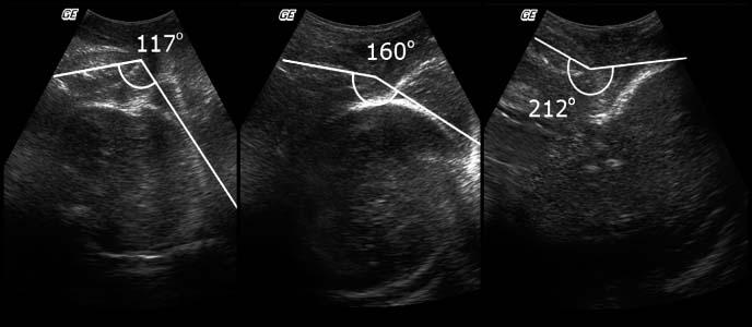 Ultraljudsbedömning av fosterhuvudets station Angle of progression (AOP) Transperinealt, sagittalplan Symfys Perineum Station mha AOP: förutsäga vaginal förlossning vid