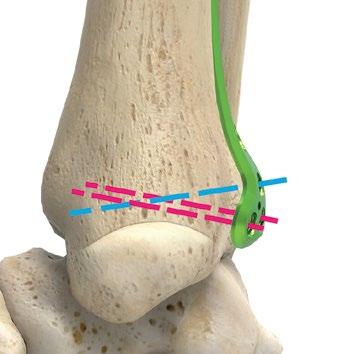 Posterolateral distal tibiaplatta operationsteknik [forts.