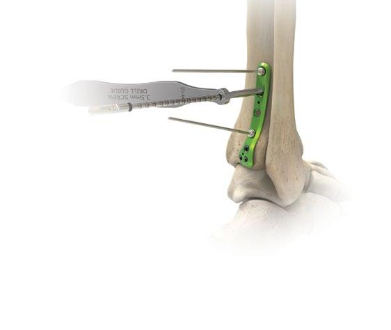 Posterolateral distal tibiaplatta operationsteknik [forts.] 5 Proximal placering av 3,5 mm sexkantsskruv 3,5 mm sexkantsskruvar passar i alla proximala platthål.